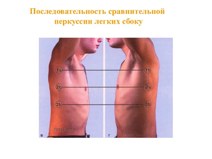 Последовательность сравнительной перкуссии легких сбоку