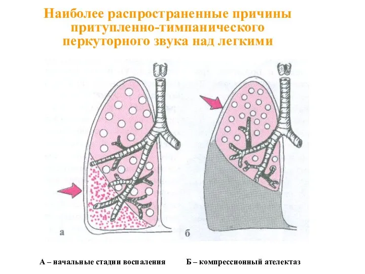 Наиболее распространенные причины притупленно-тимпанического перкуторного звука над легкими А – начальные