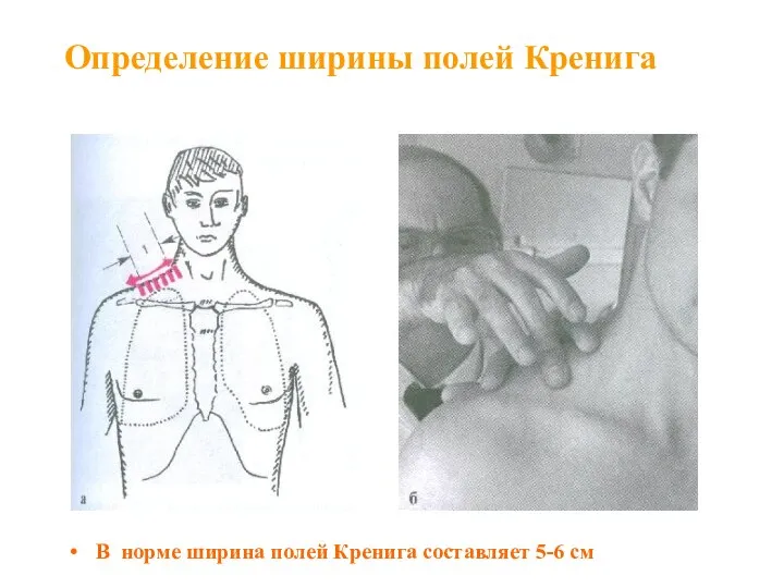 Определение ширины полей Кренига В норме ширина полей Кренига составляет 5-6 см