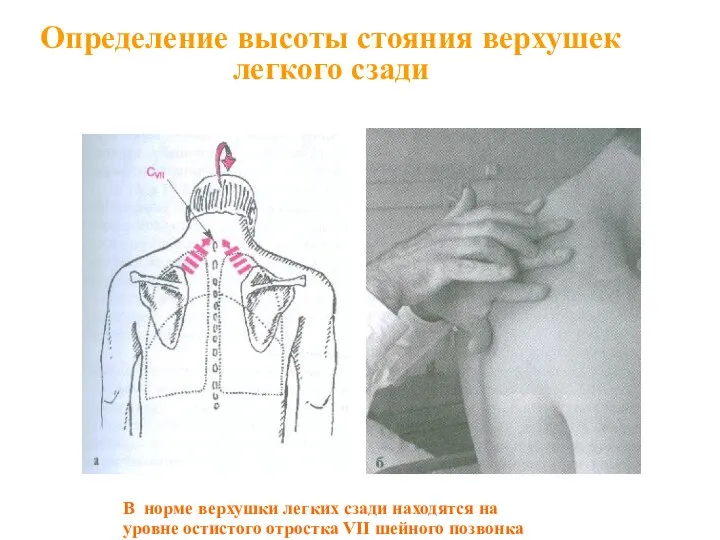 Определение высоты стояния верхушек легкого сзади В норме верхушки легких сзади