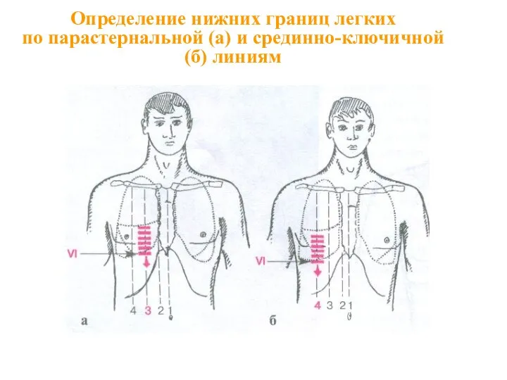 Определение нижних границ легких по парастернальной (а) и срединно-ключичной (б) линиям