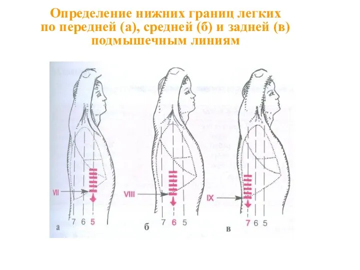 Определение нижних границ легких по передней (а), средней (б) и задней (в) подмышечным линиям