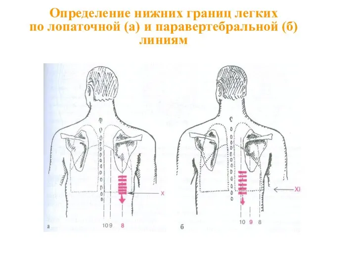 Определение нижних границ легких по лопаточной (а) и паравертебральной (б) линиям