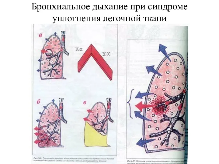 Бронхиальное дыхание при синдроме уплотнения легочной ткани