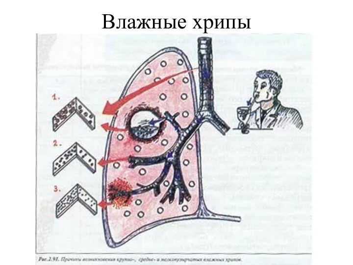 Влажные хрипы