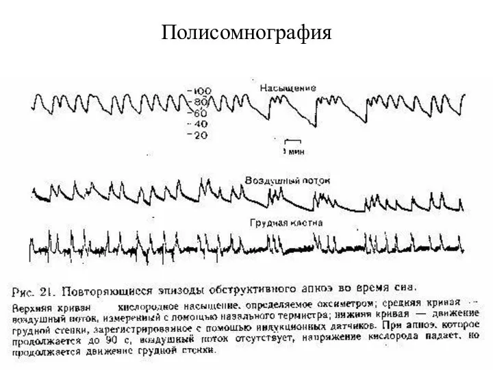 Полисомнография