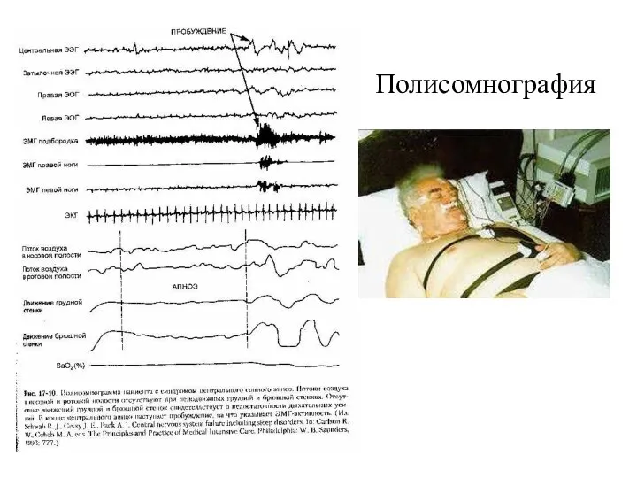 Полисомнография