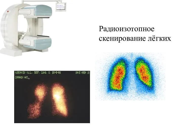 Радиоизотопное скенирование лёгких