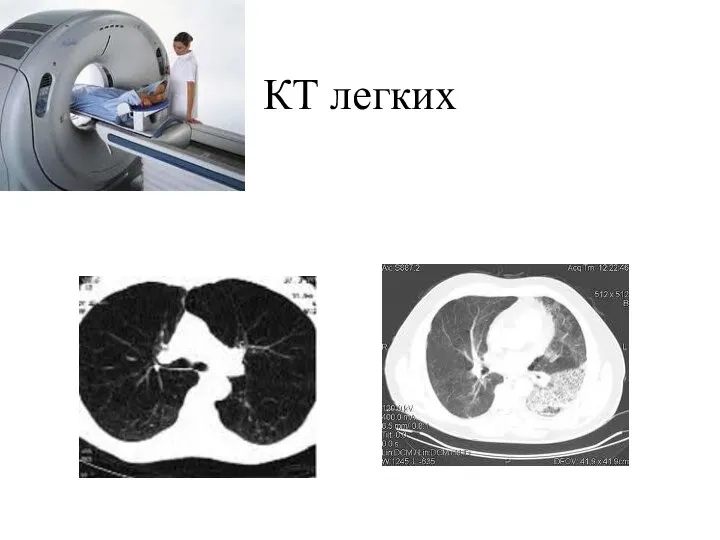 КТ легких