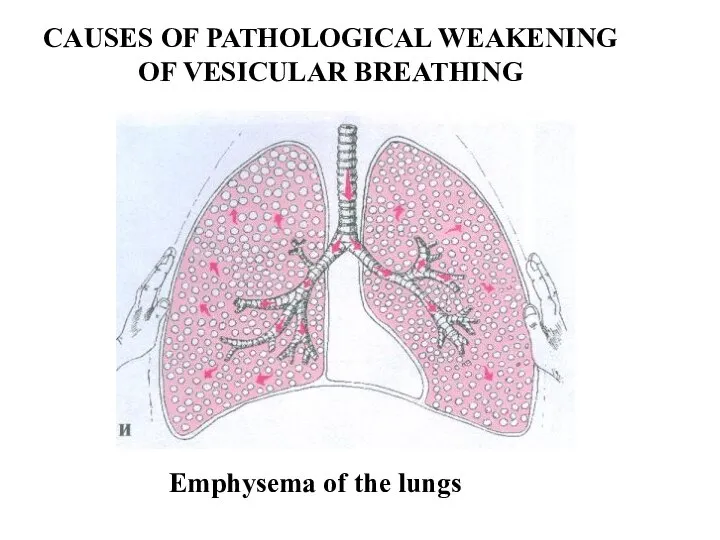 CAUSES OF PATHOLOGICAL WEAKENING OF VESICULAR BREATHING Emphysema of the lungs