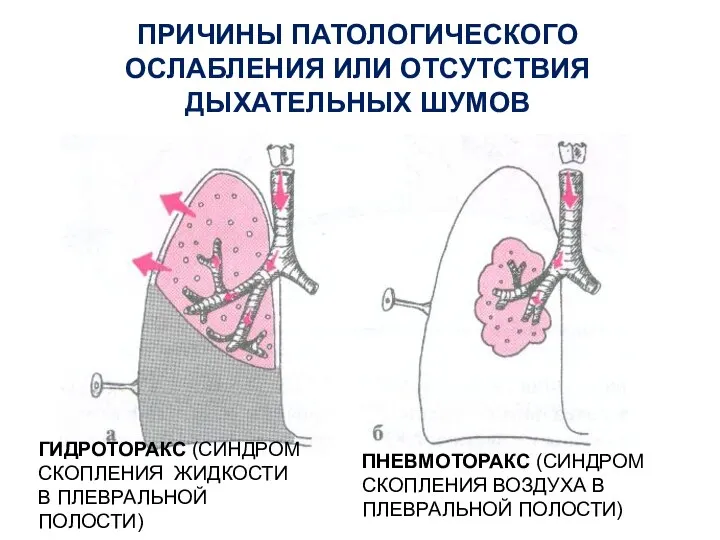 ПРИЧИНЫ ПАТОЛОГИЧЕСКОГО ОСЛАБЛЕНИЯ ИЛИ ОТСУТСТВИЯ ДЫХАТЕЛЬНЫХ ШУМОВ ПНЕВМОТОРАКС (СИНДРОМ СКОПЛЕНИЯ ВОЗДУХА