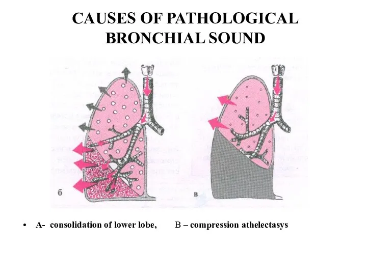 CAUSES OF PATHOLOGICAL BRONCHIAL SOUND A- consolidation of lower lobe, B – compression athelectasys