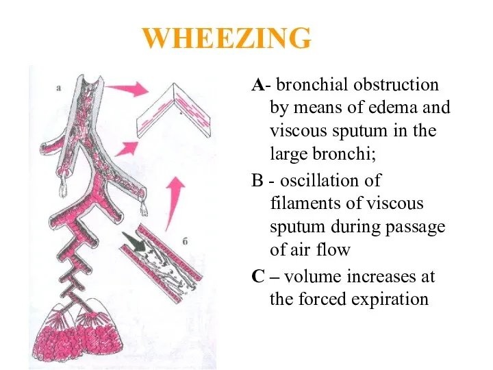 WHEEZING A- bronchial obstruction by means of edema and viscous sputum