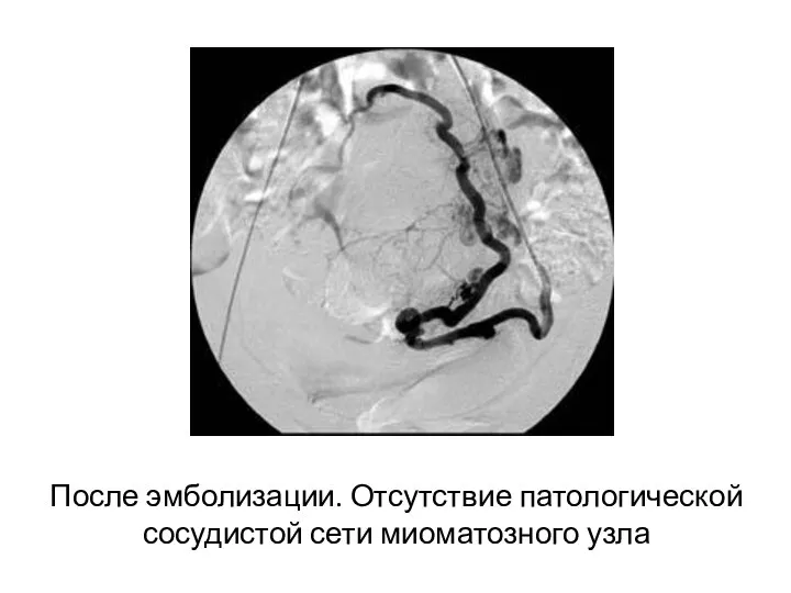 После эмболизации. Отсутствие патологической сосудистой сети миоматозного узла