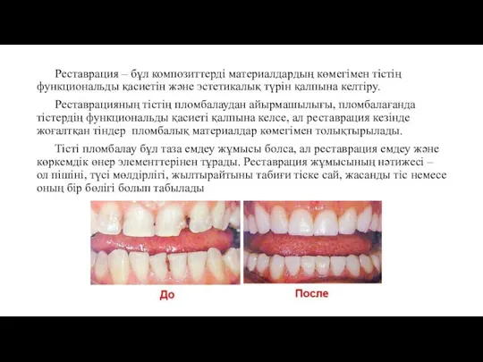 Реставрация – бұл композиттерді материалдардың көмегімен тістің функциональды қасиетін және эстетикалық