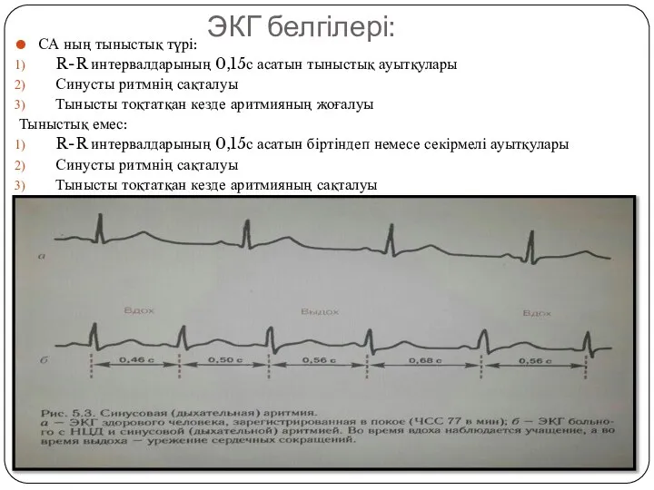 ЭКГ белгілері: СА ның тыныстық түрі: R-R интервалдарының 0,15с асатын тыныстық