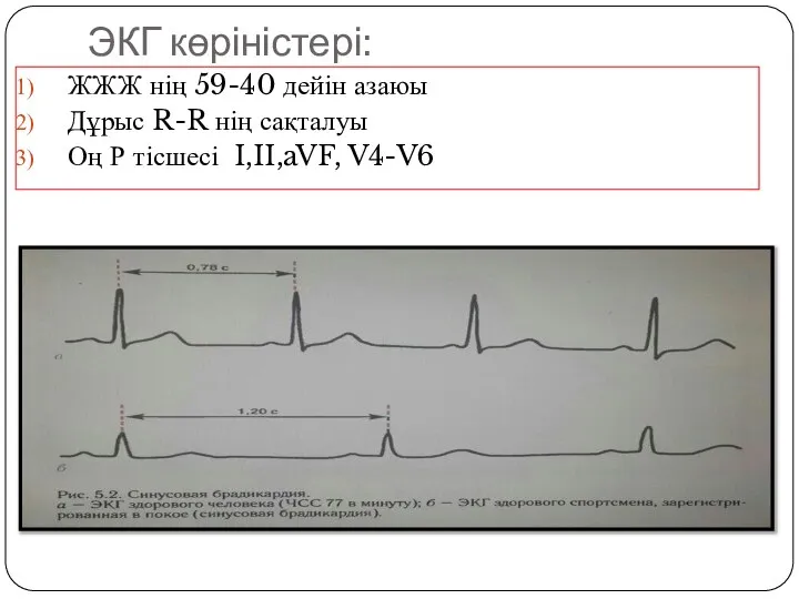 ЭКГ көріністері: ЖЖЖ нің 59-40 дейін азаюы Дұрыс R-R нің сақталуы Оң Р тісшесі I,II,aVF, V4-V6