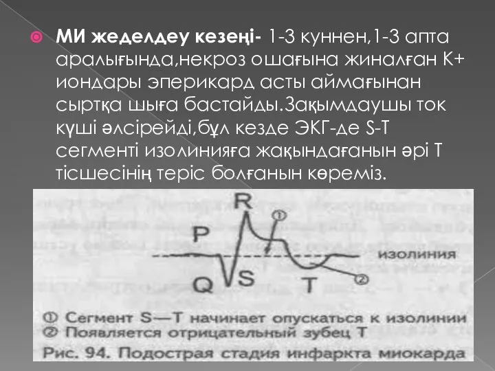 МИ жеделдеу кезеңі- 1-3 куннен,1-3 апта аралығында,некроз ошағына жиналған К+ иондары