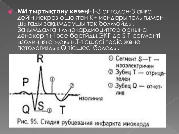 МИ тыртықтану кезеңі-1-3 аптадан-3 айға дейін,некроз ошақтан К+ иондары толығымен шығады,зақымдаушы