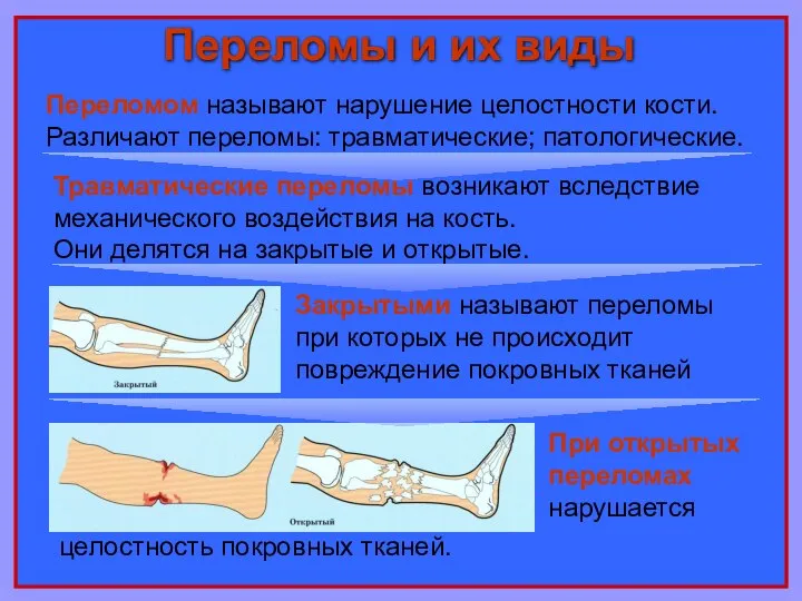 Переломы и их виды При открытых переломах нарушается Переломом называют нарушение