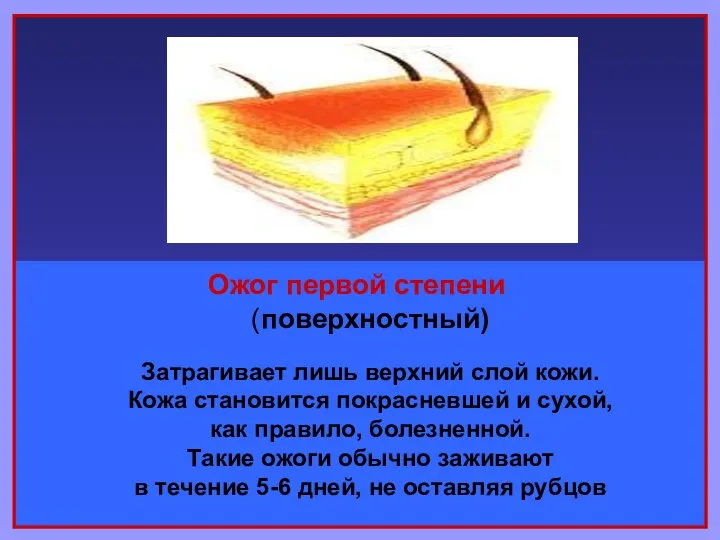 Ожог первой степени (поверхностный) Затрагивает лишь верхний слой кожи. Кожа становится