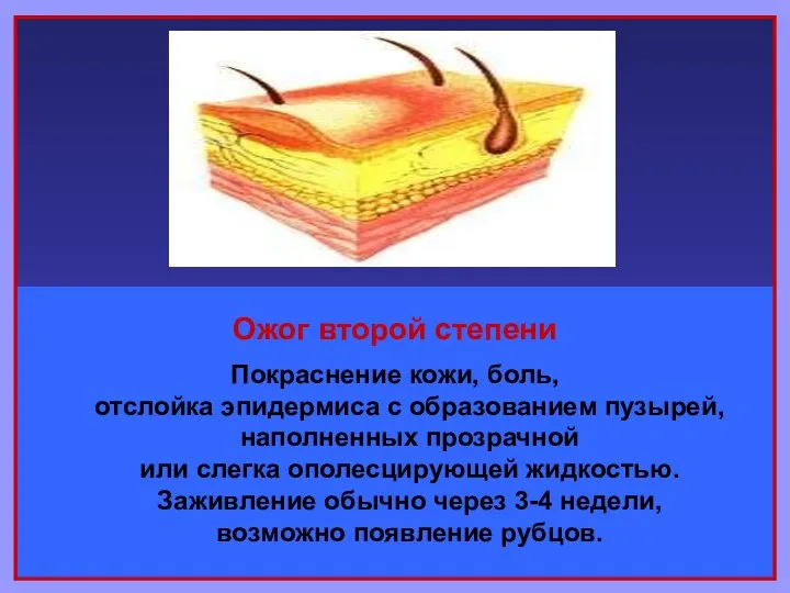 Ожог второй степени Покраснение кожи, боль, отслойка эпидермиса с образованием пузырей,