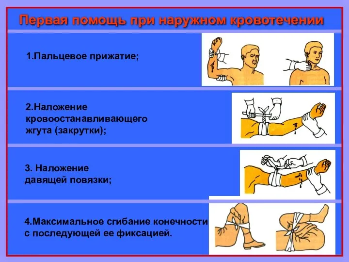 Первая помощь при наружном кровотечении 1.Пальцевое прижатие; 2.Наложение кровоостанавливающего жгута (закрутки);