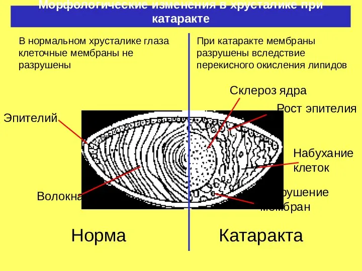 Морфологические изменения в хрусталике при катаракте Норма Эпителий Волокна Склероз ядра