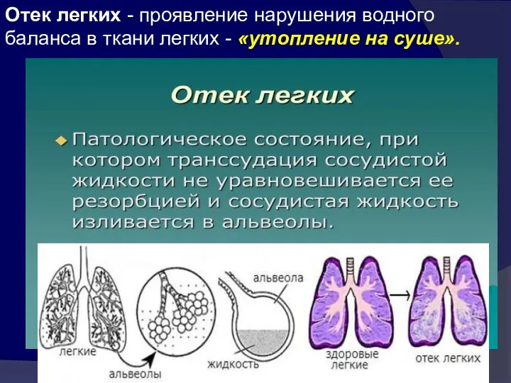 Отек легких - проявление нарушения водного баланса в ткани легких - «утопление на суше».