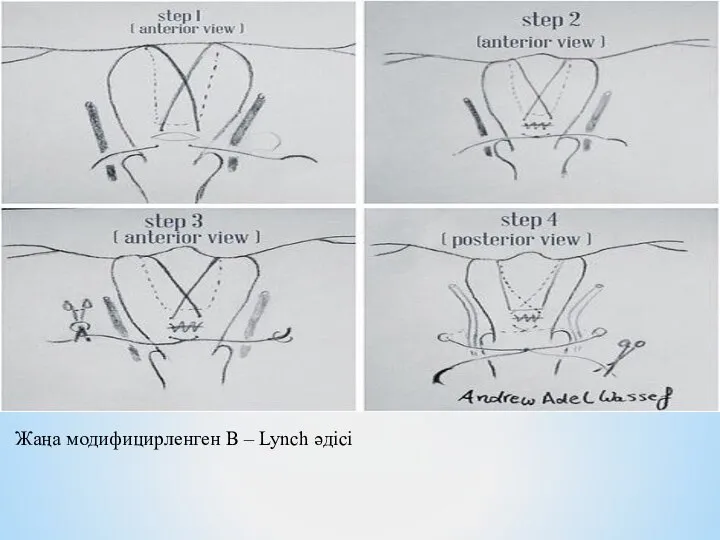 Жаңа модифицирленген B – Lynch әдісі