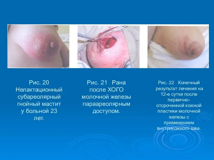 Рис. 20 Нелактационный субареолярный гнойный мастит у больной 23 лет. Рис.