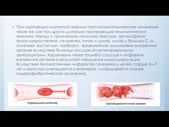 При серповидно-клеточной анемии патологоанатомические изменения такие же, как при других длительно