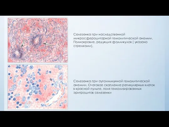 Селезенка при наследственной микросфероцитарной гемолитической анемии. Полнокровие, редукция фолликулов ( указано