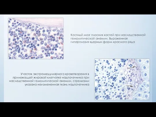Костный мозг плоских костей при наследственной гемолитической анемии. Выраженная гиперплазия ядерных