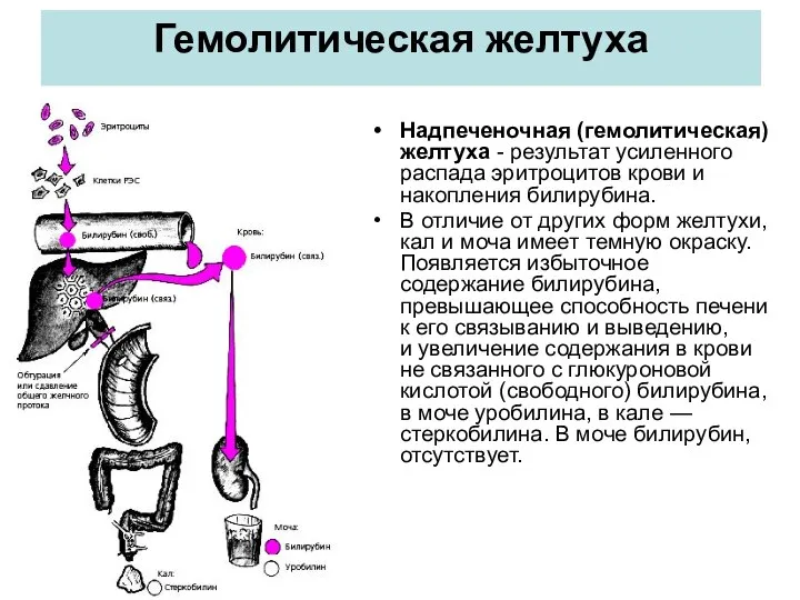 Гемолитическая желтуха Надпеченочная (гемолитическая) желтуха - результат усиленного распада эритроцитов крови