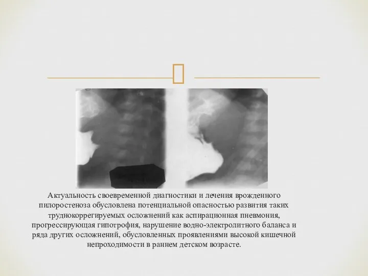 Актуальность своевременной диагностики и лечения врожденного пилоростеноза обусловлена потенциальной опасностью развития