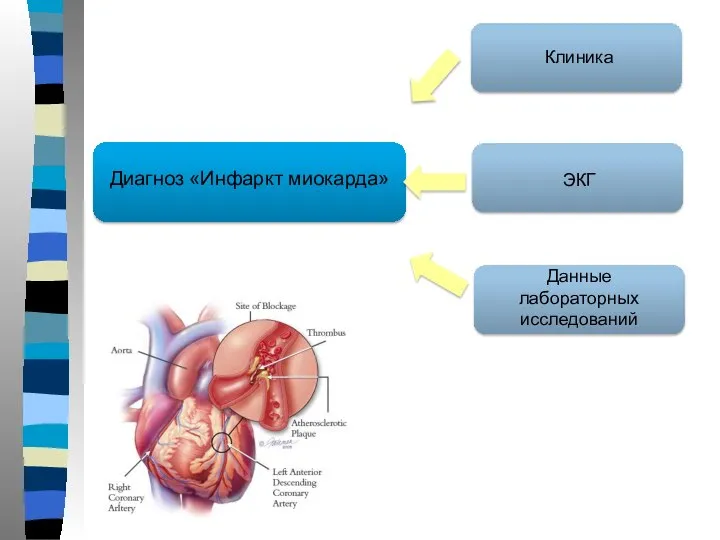 Диагноз «Инфаркт миокарда» Клиника ЭКГ Данные лабораторных исследований