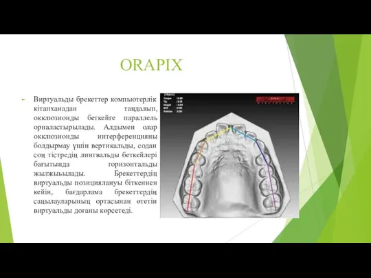 ORAPIX Виртуальды брекеттер компьютерлік кітапханадан таңдалып, окклюзионды беткейге параллель орналастырылады. Алдымен