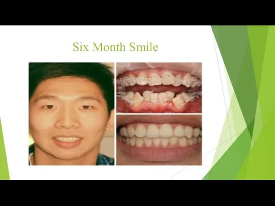 Six Month Smile