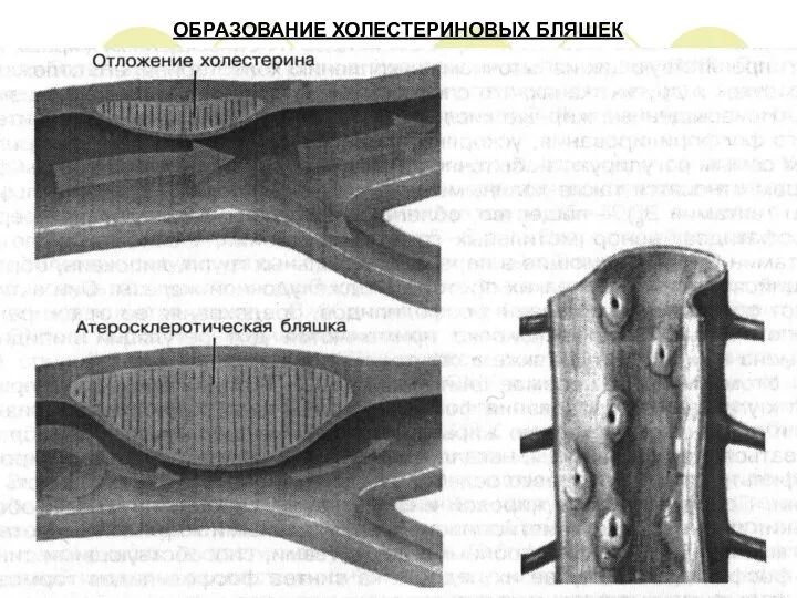 ОБРАЗОВАНИЕ ХОЛЕСТЕРИНОВЫХ БЛЯШЕК