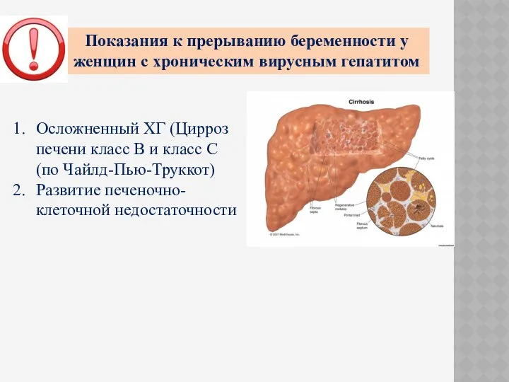 Показания к прерыванию беременности у женщин с хроническим вирусным гепатитом Осложненный