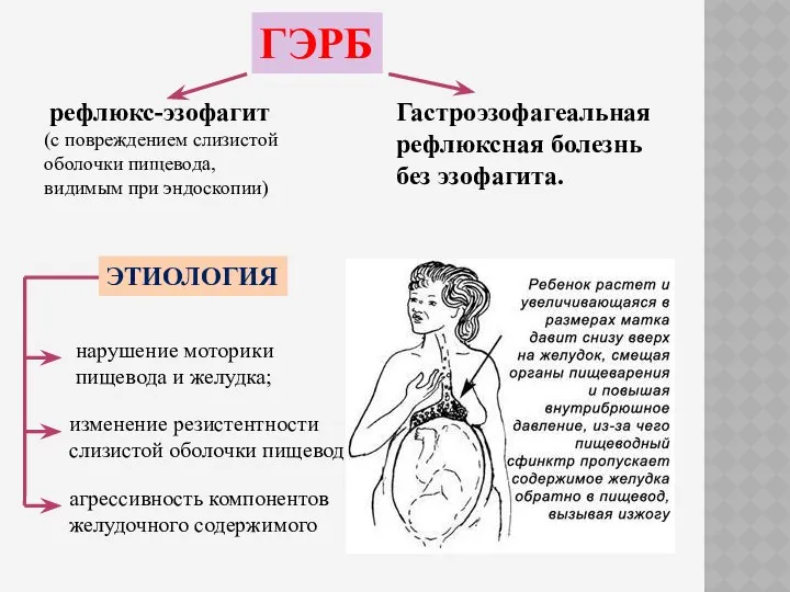 ГЭРБ рефлюкс-эзофагит (с повреждением слизистой оболочки пищевода, видимым при эндоскопии) Гастроэзофагеальная