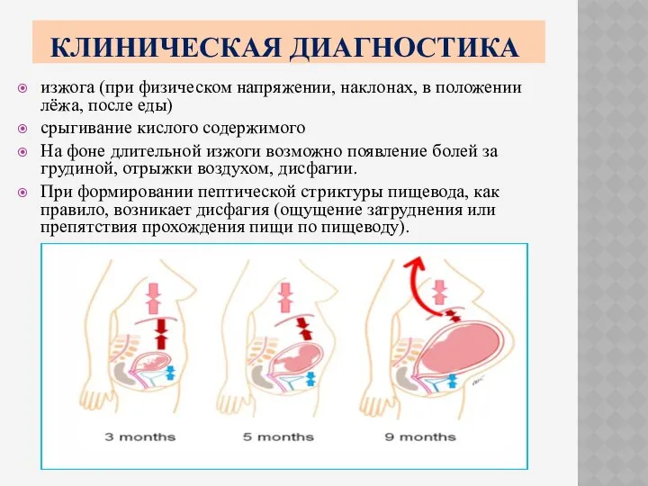 КЛИНИЧЕСКАЯ ДИАГНОСТИКА изжога (при физическом напряжении, наклонах, в положении лёжа, после