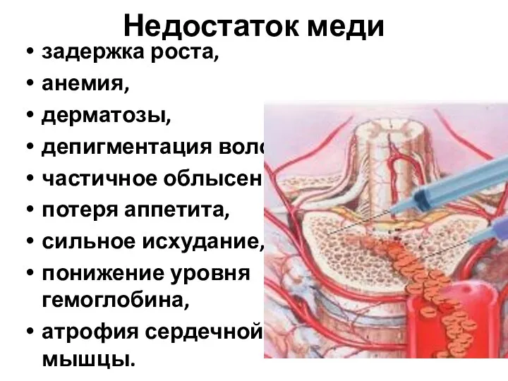 Недостаток меди задержка роста, анемия, дерматозы, депигментация волос, частичное облысение, потеря