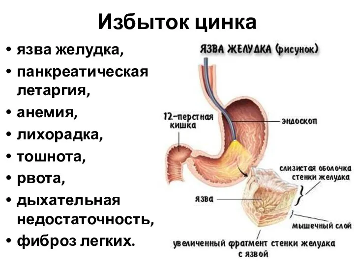 Избыток цинка язва желудка, панкреатическая летаргия, анемия, лихорадка, тошнота, рвота, дыхательная недостаточность, фиброз легких.