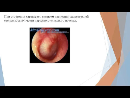 При отоскопии характерен симптом нависания задневерхней стенки костной части наружного слухового прохода.