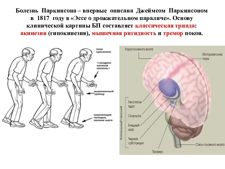 Болезнь Паркинсона – впервые описана Джеймсом Паркинсоном в 1817 году в