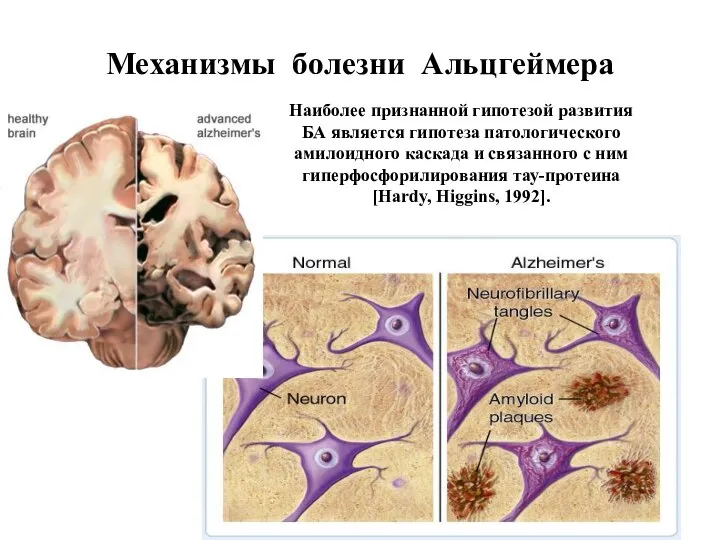 Механизмы болезни Альцгеймера Наиболее признанной гипотезой развития БА является гипотеза патологического