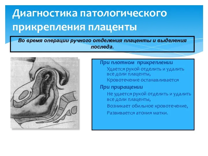 Диагностика патологического прикрепления плаценты При плотном прикреплении Удается рукой отделить и