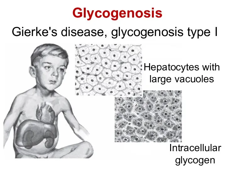 Glycogenosis Gierke's disease, glycogenosis type I Hepatocytes with large vacuoles Intracellular glycogen